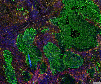 Squamous cell carcinoma graphic