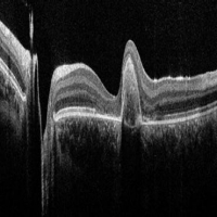 Optical Coherence Tomography (OCT)