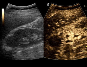 Renal Ultrasound