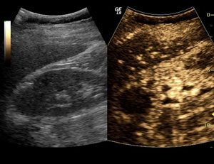 Contrast-enhanced renal ultrasound showing a renal cell carcinoma 3 months post cryoablation. Nonlinear signal is observed from microbubbles (right image) within the active blood supply in the kidney and liver. However, a complete lack of signal is observed within the treated mass, indicating no residual vascularity and effective treatment. Renal Ultrasound