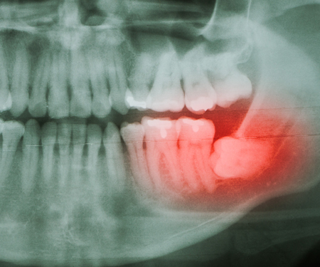 Pre-Emptive Cognitive Analgesia for Wisdom Tooth Resection Patients