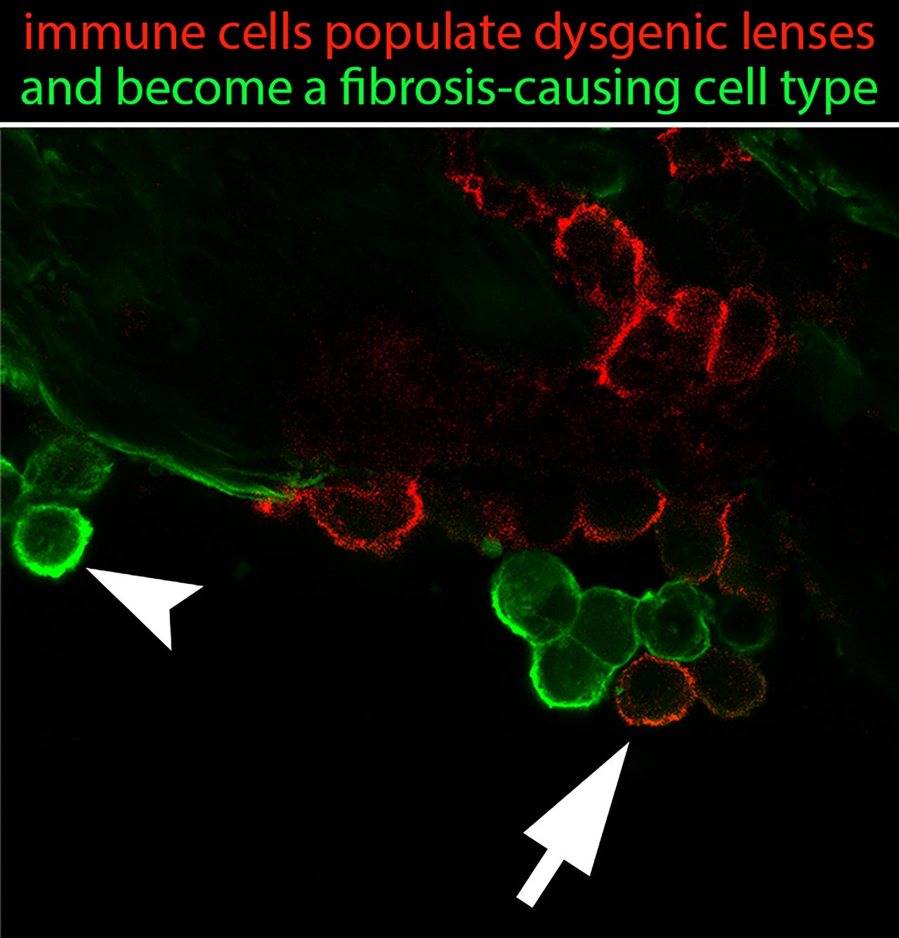 project 2 -  immune cells populate dysgenic lenses and become a fibrosis-causing cell type