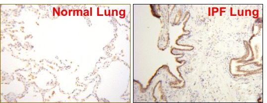 Chromatin remodeling proteins can be differentially expressed in normal vs. diseased lung resulting in altered gene expression patterns and cell phenotypes. Example of epithelial expression of chromatin modifiying proteins in normal and IPF lungs.
