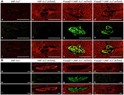 NP cells retrovirally transduced with tandem mCherry-EGFP-LC3B construct, showing yellow/green autophagosomes and red autolysosomes. file - HIF1A function and regulation