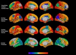 Increased WM and GM in boys with XYY 