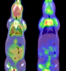 PET / CT Scans