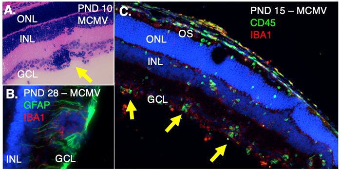 CMV-induced pathology in the developing retina