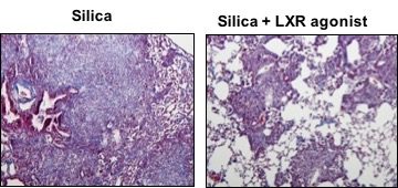 Treatment of mice with LXR agonist to enhance lipid synthesis, decreases ER stress and attenuates lung fibrosis in response to silica. project1 - Pulmonary Fibrosis is a metabolic disorder of the lung